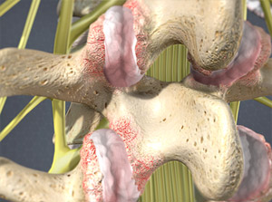 Facet-joint-pain